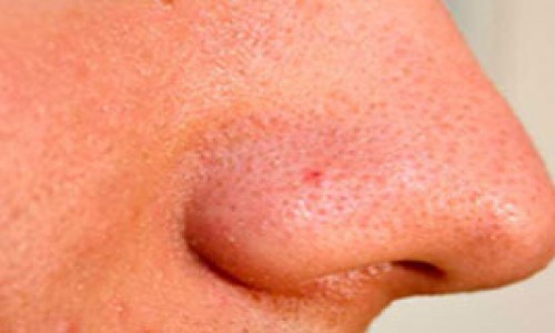 OPEN PORES treatment