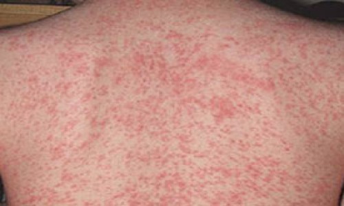 SKIN ALLERGY treatment