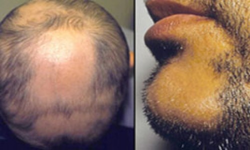 PATCHY HAIR LOSS treatment