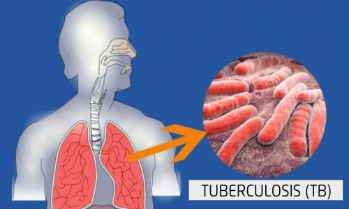tuberculosis (क्षय रोग )