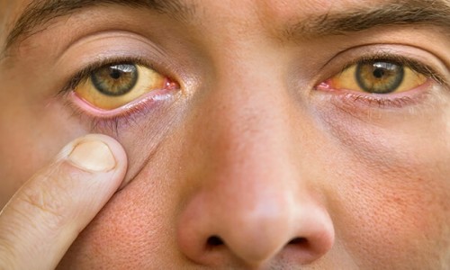 Jaundice