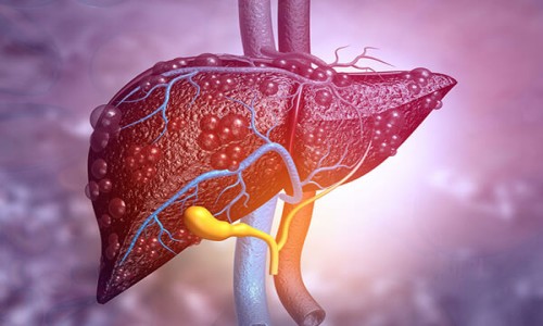 Liver Cirrhosis