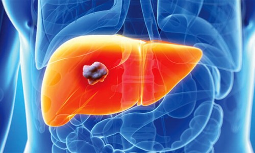 Liver Cancer