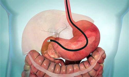 ERCP