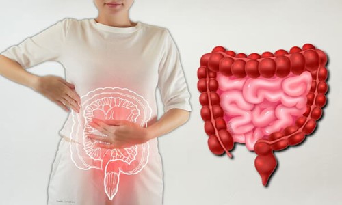 IBD   Ulcerative Colitis