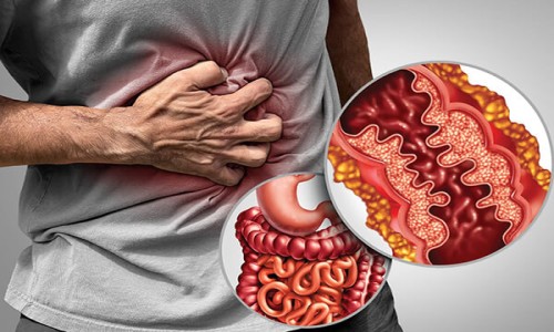 IBD   Crohn s Disease